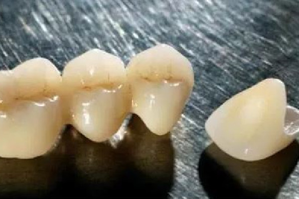 烤瓷牙掉了怎么辦可以粘回去嗎 烤瓷牙掉了多久之內(nèi)必須粘回去 烤瓷牙掉了怎么辦可以粘回去嗎 烤瓷牙掉了多久之內(nèi)必須粘回去