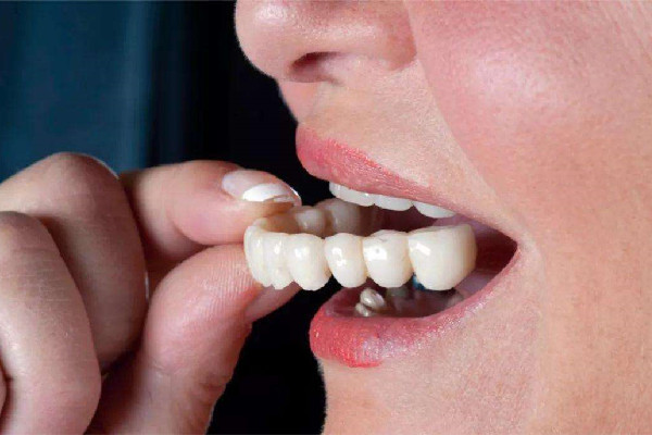 烤瓷牙和全瓷牙哪種好 烤瓷牙和全瓷牙價格 烤瓷牙和全瓷牙哪種好 烤瓷牙和全瓷牙價格