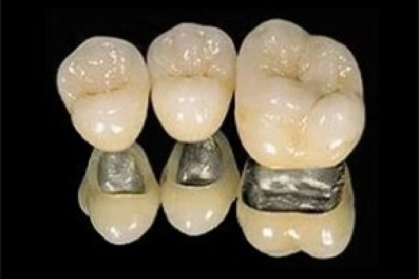 烤瓷牙的材料有幾種 烤瓷牙用什么膠粘最好 烤瓷牙的材料有幾種 烤瓷牙用什么膠粘最好