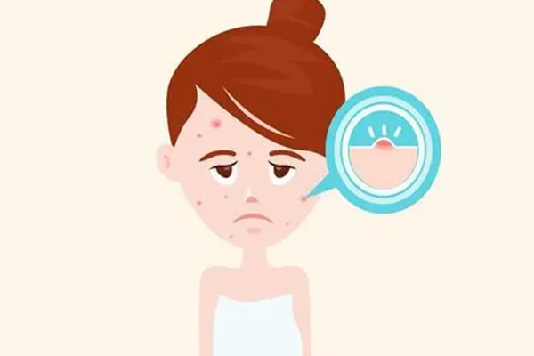 脂肪粒能用甘油去除嗎 脂肪粒發(fā)癢是怎么回事 脂肪粒能用甘油去除嗎 脂肪粒發(fā)癢是怎么回事