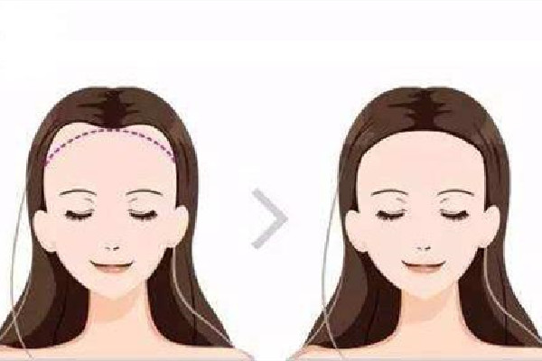 發(fā)際線幾種形狀 發(fā)際線什么樣的比較好 發(fā)際線幾種形狀 發(fā)際線什么樣的比較好