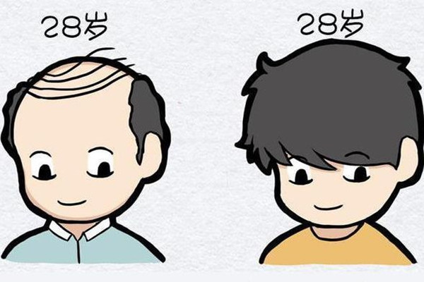 種植發(fā)際線能維持多久 種植發(fā)際線是永久的嗎 種植發(fā)際線能維持多久 種植發(fā)際線是永久的嗎