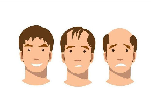 發(fā)際線會長回來嗎 發(fā)際線和年齡有關系嗎 發(fā)際線會長回來嗎 發(fā)際線和年齡有關系嗎