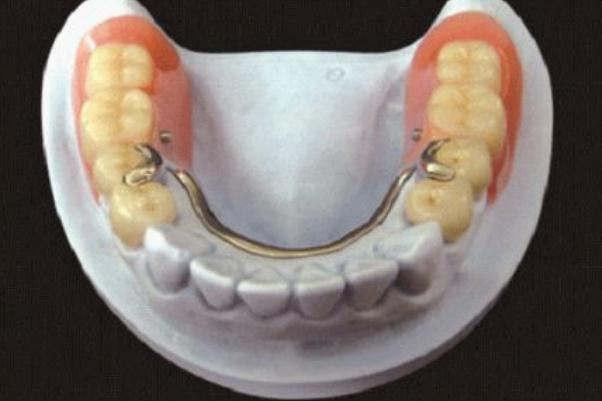 鑲牙多少錢(qián)一顆牙 鑲牙和種牙的區(qū)別 鑲牙多少錢(qián)一顆牙 鑲牙和種牙的區(qū)別