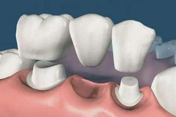 鑲牙多少錢(qián)一顆牙 鑲牙和種牙的區(qū)別 鑲牙多少錢(qián)一顆牙 鑲牙和種牙的區(qū)別