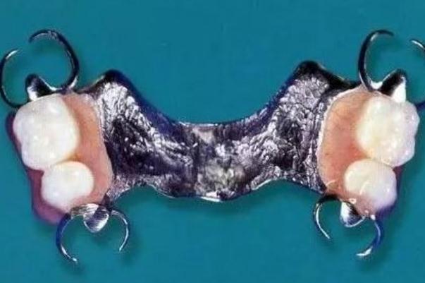 鑲牙要多長時間才能完成 鑲牙后的注意事項 鑲牙要多長時間才能完成 鑲牙后的注意事項