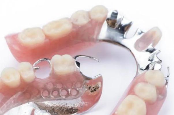 鑲牙要多長時間才能完成 鑲牙后的注意事項 鑲牙要多長時間才能完成 鑲牙后的注意事項