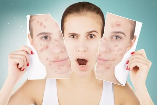 痘痘能用手?jǐn)D嗎 痘痘擠了會(huì)不會(huì)留疤 痘痘能用手?jǐn)D嗎 痘痘擠了會(huì)不會(huì)留疤