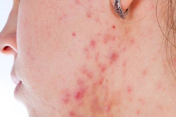 痘痘擠了之后能用酒精消毒嗎 痘痘擠了之后能用蘆薈膠嗎 痘痘擠了之后能用酒精消毒嗎 痘痘擠了之后能用蘆薈膠嗎