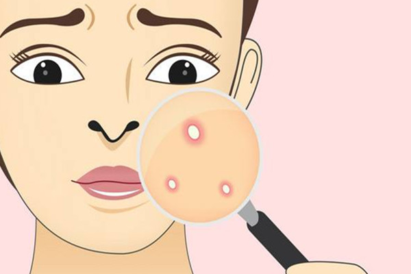 痘痘長(zhǎng)到多少歲 長(zhǎng)痘需要注意些什么 痘痘長(zhǎng)到多少歲 長(zhǎng)痘需要注意些什么