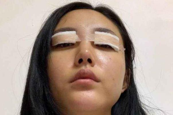 割雙眼皮有哪些風險 割雙眼皮有哪些副作用 割雙眼皮有哪些風險 割雙眼皮有哪些副作用