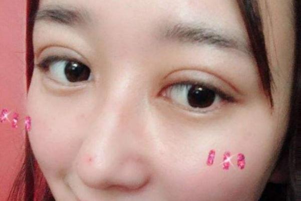 割雙眼皮會(huì)傷害眼睛嗎 割雙眼皮會(huì)割到眼部神經(jīng)嗎 割雙眼皮會(huì)傷害眼睛嗎 割雙眼皮會(huì)割到眼部神經(jīng)嗎