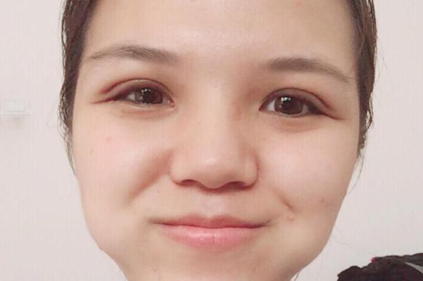 割雙眼皮會(huì)傷害眼睛嗎 割雙眼皮會(huì)割到眼部神經(jīng)嗎 割雙眼皮會(huì)傷害眼睛嗎 割雙眼皮會(huì)割到眼部神經(jīng)嗎