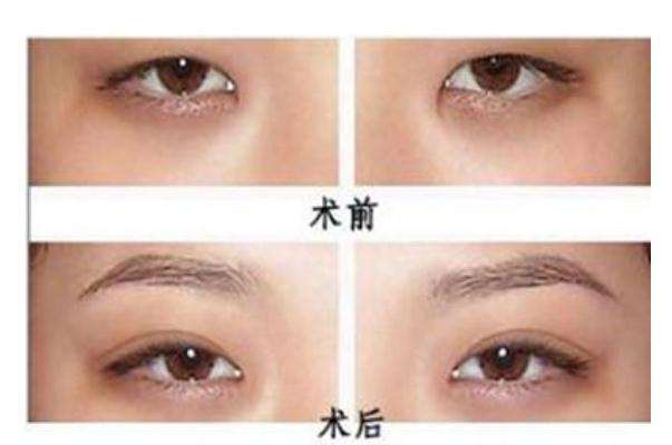 割雙眼皮是去醫(yī)院好還是整形醫(yī)院好 割雙眼皮是冬天好還是夏天好 割雙眼皮是去醫(yī)院好還是整形醫(yī)院好 割雙眼皮是冬天好還是夏天好