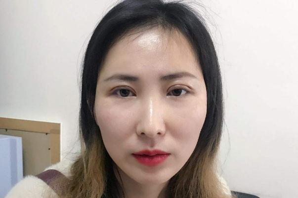 割雙眼皮對(duì)視力有影響嗎 割雙眼皮可以維持一輩子嗎 割雙眼皮對(duì)視力有影響嗎 割雙眼皮可以維持一輩子嗎