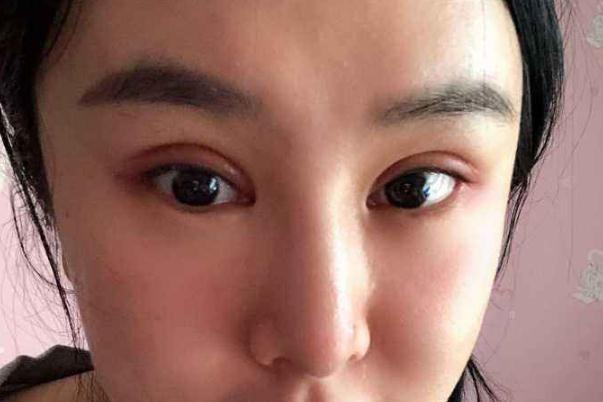 割雙眼皮是幾級(jí)疼痛 割雙眼皮要多長(zhǎng)時(shí)間完成 割雙眼皮是幾級(jí)疼痛 割雙眼皮要多長(zhǎng)時(shí)間完成