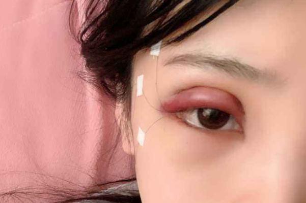 割雙眼皮對(duì)視力有影響嗎 割雙眼皮可以維持一輩子嗎 割雙眼皮對(duì)視力有影響嗎 割雙眼皮可以維持一輩子嗎