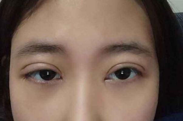 割雙眼皮有哪些風險 割雙眼皮有哪些副作用 割雙眼皮有哪些風險 割雙眼皮有哪些副作用