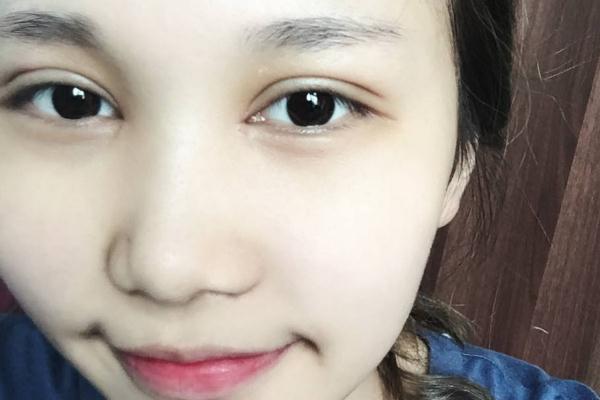 割雙眼皮對(duì)視力有影響嗎 割雙眼皮可以維持一輩子嗎 割雙眼皮對(duì)視力有影響嗎 割雙眼皮可以維持一輩子嗎