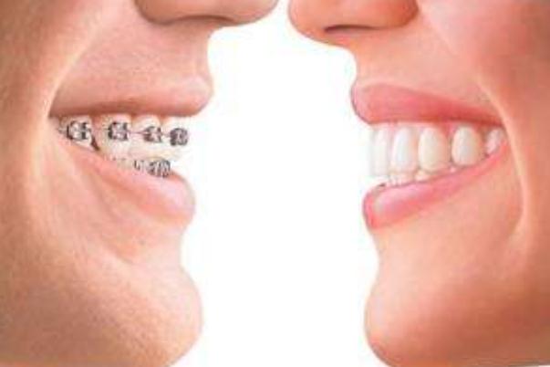 牙套是上下牙一起戴嗎 牙套是怎么矯正牙齒的 牙套是上下牙一起戴嗎 牙套是怎么矯正牙齒的