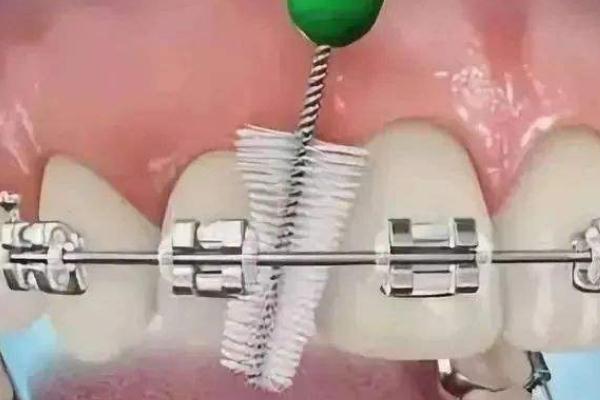 牙套對牙齒有損害嗎 牙套對核磁共振檢查有影響嗎 牙套對牙齒有損害嗎 牙套對核磁共振檢查有影響嗎