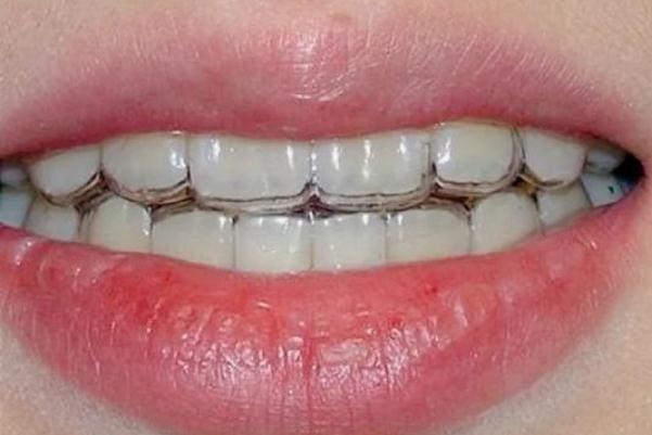 隱形牙套費(fèi)用大概多少 隱形牙套和鋼絲牙套哪個(gè)效果更好 隱形牙套費(fèi)用大概多少 隱形牙套和鋼絲牙套哪個(gè)效果更好