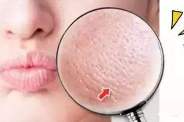 收縮毛孔會(huì)不會(huì)長痘 造成毛孔粗大的因素