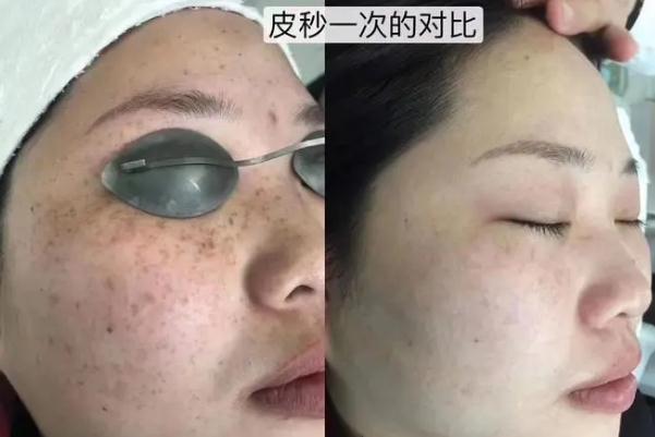 皮秒祛斑的費(fèi)用一般是多少 皮秒祛斑的危害與效果 皮秒祛斑的費(fèi)用一般是多少 皮秒祛斑的危害與效果