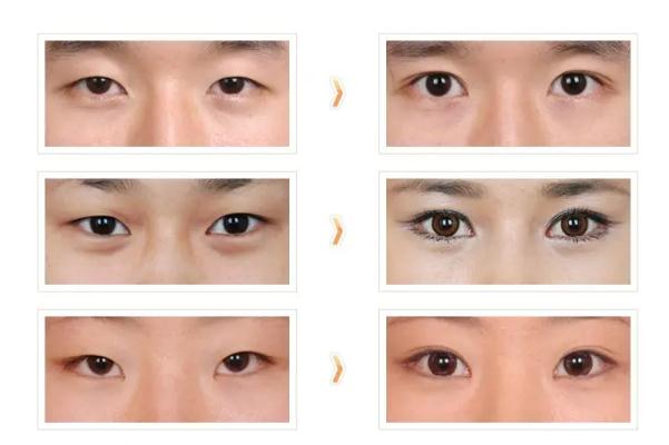 開(kāi)眼角的恢復(fù)期是多久 開(kāi)眼角要多久才能恢復(fù)正常