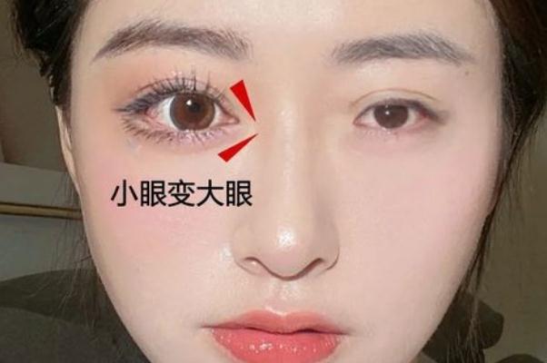 開眼角手術(shù)一般需要多少錢 開眼角手術(shù)危險嗎