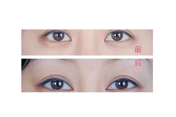 開眼角有必要嗎 開眼角會長回去嗎 開眼角有必要嗎 開眼角會長回去嗎