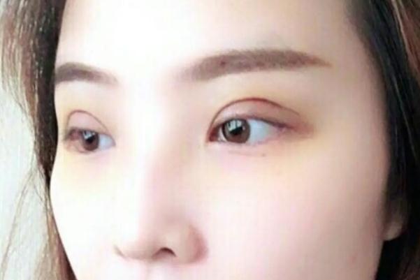 開(kāi)眼角是啥意思 開(kāi)眼角是大手術(shù)嗎 開(kāi)眼角是啥意思 開(kāi)眼角是大手術(shù)嗎