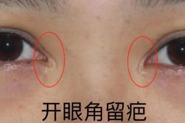 開眼角手術(shù)一般需要多少錢 開眼角手術(shù)危險嗎