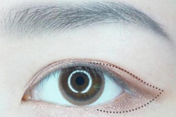 開(kāi)眼角是啥意思 開(kāi)眼角是大手術(shù)嗎 開(kāi)眼角是啥意思 開(kāi)眼角是大手術(shù)嗎