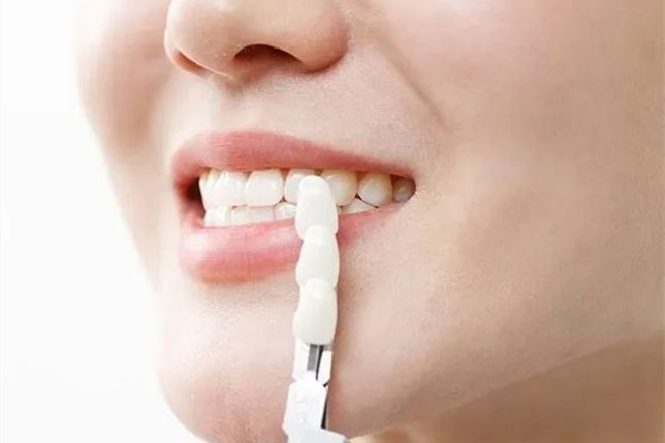 牙齒美白可以去煙漬嗎 牙齒美白做一次有用嗎 牙齒美白可以去煙漬嗎 牙齒美白做一次有用嗎