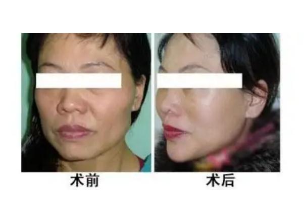 肉毒素除皺的注意事項(xiàng) 肉毒素除皺是永久的嗎 肉毒素除皺的注意事項(xiàng) 肉毒素除皺是永久的嗎