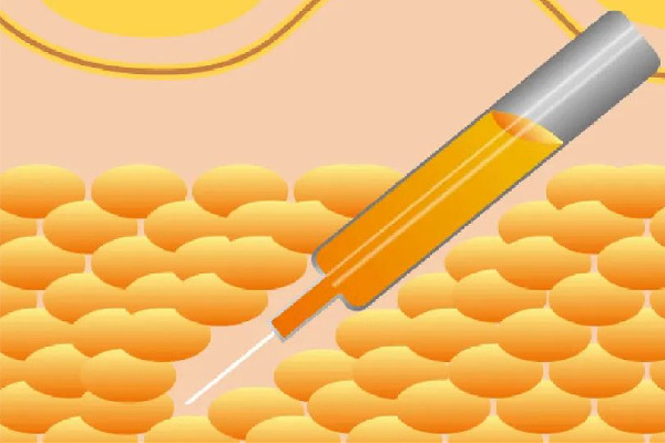 吸脂可以報醫(yī)保嗎 吸脂去三甲醫(yī)院還是美容醫(yī)院 吸脂可以報醫(yī)保嗎 吸脂去三甲醫(yī)院還是美容醫(yī)院