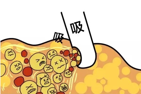 吸脂手術(shù)大概要多少錢 吸脂一次最多吸多少 吸脂手術(shù)大概要多少錢 吸脂一次最多吸多少