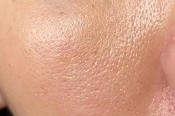 毛孔粗大有黑頭怎么辦 毛孔粗大能修復(fù)嗎 毛孔粗大有黑頭怎么辦 毛孔粗大能修復(fù)嗎