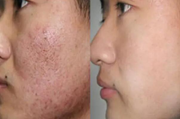 毛孔粗大有色斑怎么改善 毛孔粗大有什么危害 毛孔粗大有色斑怎么改善 毛孔粗大有什么危害