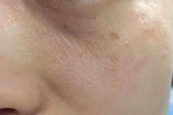 毛孔粗大是缺乏什么維生素 毛孔粗大是什么意思 毛孔粗大是缺乏什么維生素 毛孔粗大是什么意思