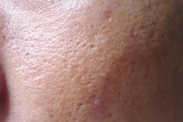 毛孔粗大要補(bǔ)水還是控油 毛孔粗大要不要用洗面奶 毛孔粗大要補(bǔ)水還是控油 毛孔粗大要不要用洗面奶