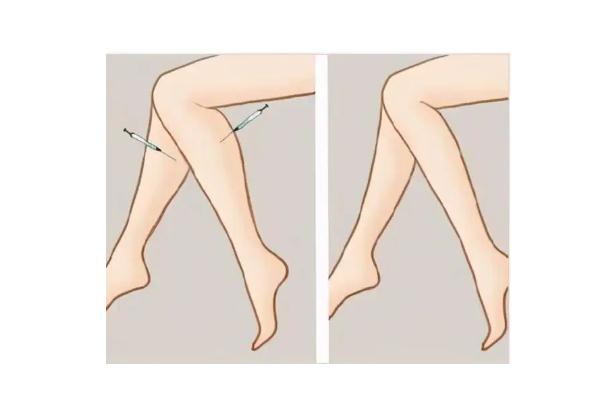 瘦腿針真的能瘦腿嗎 瘦腿針有沒有副作用 瘦腿針真的能瘦腿嗎 瘦腿針有沒有副作用