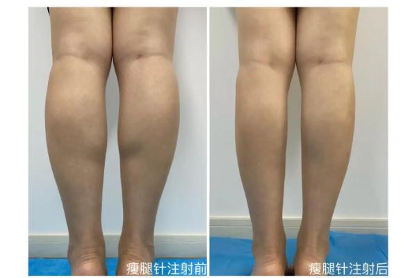 瘦腿針真的能瘦腿嗎 瘦腿針有沒有副作用 瘦腿針真的能瘦腿嗎 瘦腿針有沒有副作用