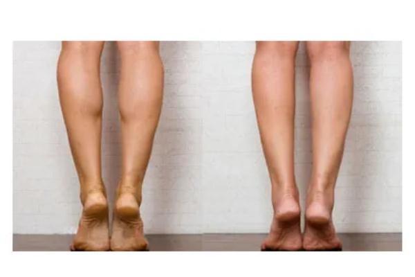 瘦腿針是溶脂針嗎 瘦腿針要一直打嗎 瘦腿針是溶脂針嗎 瘦腿針要一直打嗎