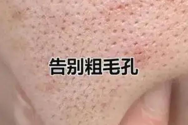 毛孔粗大怎么辦怎么收縮毛孔 毛孔粗大用什么護(hù)膚品可以改善 毛孔粗大怎么辦怎么收縮毛孔 毛孔粗大用什么護(hù)膚品可以改善