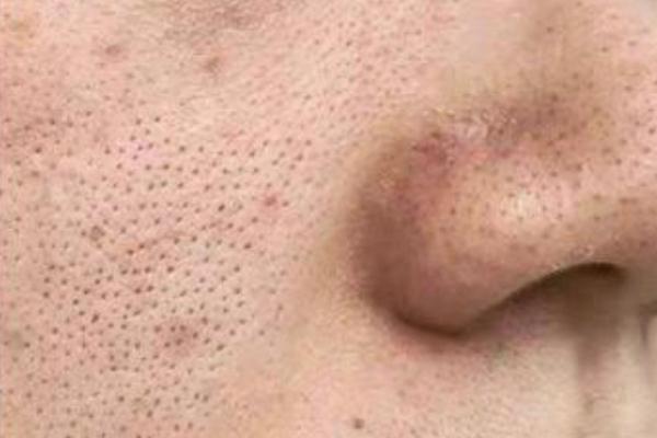 毛孔粗大怎么辦怎么收縮毛孔 毛孔粗大用什么護(hù)膚品可以改善 毛孔粗大怎么辦怎么收縮毛孔 毛孔粗大用什么護(hù)膚品可以改善