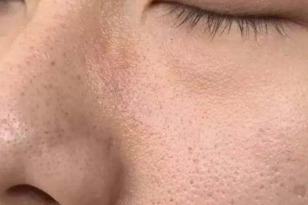 毛孔粗大會(huì)自己慢慢變小嗎 毛孔粗大會(huì)持續(xù)一輩子嗎 毛孔粗大會(huì)自己慢慢變小嗎 毛孔粗大會(huì)持續(xù)一輩子嗎