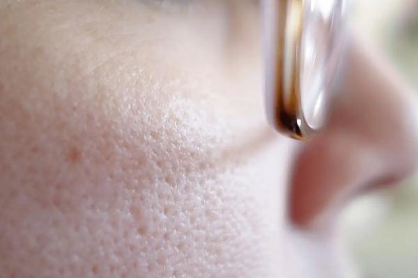 毛孔粗大要補(bǔ)水還是控油 毛孔粗大要不要用洗面奶 毛孔粗大要補(bǔ)水還是控油 毛孔粗大要不要用洗面奶