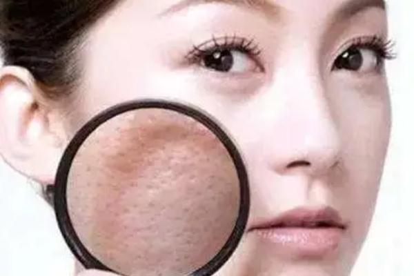 毛孔粗大有痘坑怎么修復(fù) 毛孔粗大有幾種類型 毛孔粗大有痘坑怎么修復(fù) 毛孔粗大有幾種類型